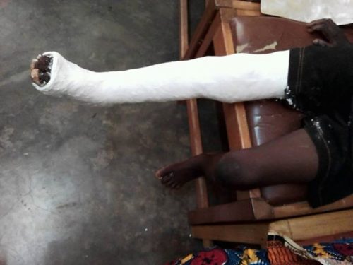 broken leg in plaster cast 